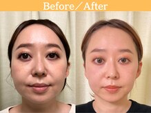 【実録】小顔矯正で理想のフェイスラインへ、 6回でここまで変わる！小顔矯正の軌跡と確かな変化をご紹介