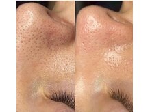トウキョウビューティーラボ(TOKYO BEAUTY LABO.)/Before&After(ハイドラ)