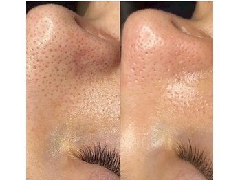 トウキョウビューティーラボ(TOKYO BEAUTY LABO.)/Before&After(ハイドラ)