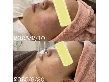 テテアテテ(tete a tete)/脱毛と一緒に【お肌悩みも改善】