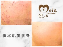 わたしもこのエステでニキビ改善できました！お任せください◎