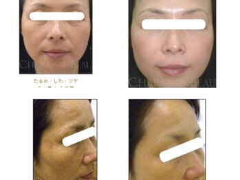 ミヤビ(MIYABI)の写真/長年のほうれい線悩みを改善！口角・フェイスラインのもたつきなど、気になる箇所へ徹底アプローチ◎