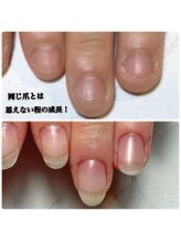 スマイルニコ(smile nico)/深爪がこんなに伸びる