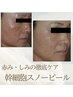 赤み・くすみ・しみにお悩みの方◎幹細胞スノーピール￥18,000