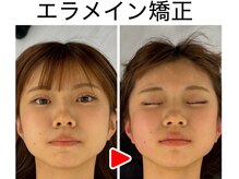 エレヴィザ トウキョウ 恵比寿院(ELVISA TOKYO)/左右差・面長改善 /　初回施術