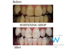 ホワイトニングショップ 甲賀店/Before&After『ホワイトニング』