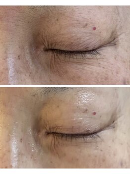 ナル(naru.)/臍帯羊膜3回で目元ふっくら