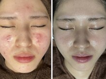 リボーン(REBORN)/ニキビケア