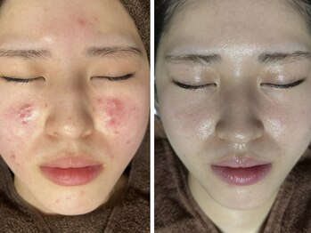 リボーン(REBORN)/ニキビケア