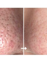 カミーシャ(KaMi-Sha)/【30代女性】毛穴改善症例写真