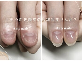 アーティネイルズ(Aaty Nails)/爪は改善できます