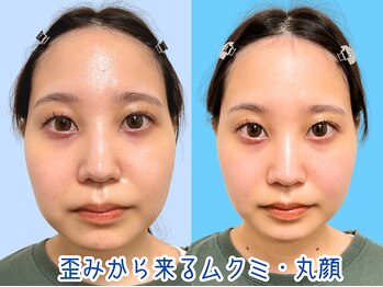 ナチュラルビューティーフェイス 横浜(NBF)/ムクミから来る丸顔/横浜小顔