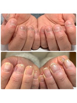 ウェルネスマルカ(wellness MARCA)/深爪矯正