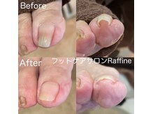 ラフィネ(Raffine)の雰囲気（巻き爪改善ご相談ください）