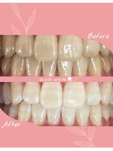 エクシアホワイトニング 札幌中島公園店/ホワイトニングビフォーアフター