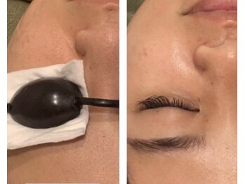 キミドリ(KIMIDORI)/BBL光フェイシャル