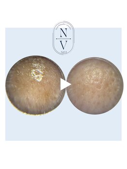 ナビ(NAVI)/毛穴ケア／シミケア