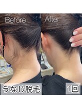 イリス(Iris)/「ついでにうなじ脱毛」増加中☆