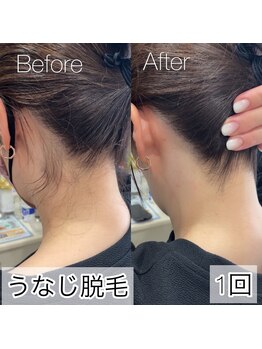 イリス(Iris)/「ついでにうなじ脱毛」増加中☆