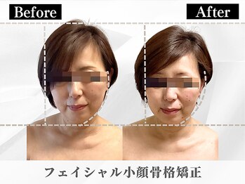ポーベルポー(Peau Belle poe)/フェイシャル小顔矯正＋パック