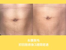 エクレ 柏店(EKURE)/お腹脱毛