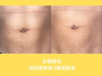 エクレ 柏店(EKURE)/お腹脱毛