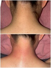 アンヴィオ ギンザコウフ(Anvio GINZA KOFU)/うなじワックス脱毛