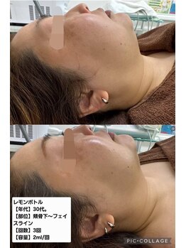 アオダモ(aodamo)/