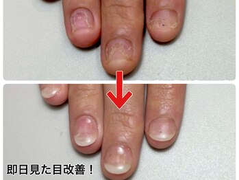 レアムネイル(Leam nail)/即日見た目改善！