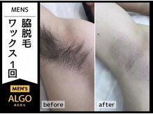 アルゴ 敦賀店(ALGO)/20代男性1回目　脇WAX脱毛