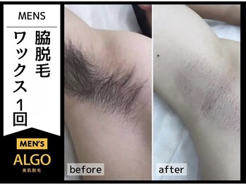 アルゴ 敦賀店(ALGO)/20代男性1回目　脇WAX脱毛