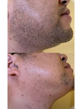 ジェムの森/ひげ脱毛 before after写真