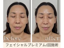 パーソナル ユニ(uni)/マツヤニプレミアム1回施術
