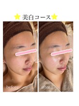 ムム(MooMoo)/美白コース