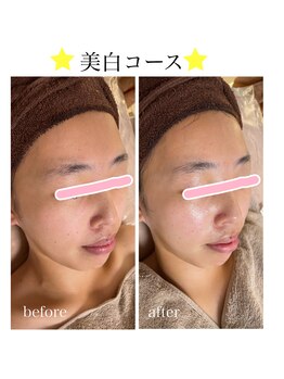 ムム(MooMoo)/美白コース