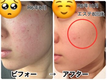 サロンドボーテ ヴィクトワール マルヤマ(Salon de beaute VICTOIRE MARUYAMA)/エンビロンフルトリートメント