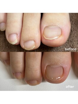 リリ(lili)/フットネイルスキンケア1回目