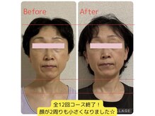 ベルフルール(Belle Fleur)/小顔矯正