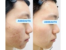 アスポーテ(ASBEAUTE)の雰囲気（ニキビ改善/ニキビケア/大人ニキビ）