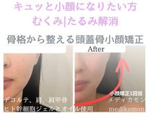 リピート率90％。歪み、面長、丸顔、のっぺり顔も立体小顔美人