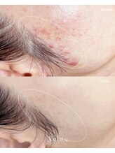 ユーエステティック(U AESTHETIC)/揺らぎ肌のための毛穴ケア