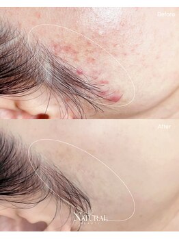 ユーエステティック(U AESTHETIC)/揺らぎ肌のための毛穴ケア