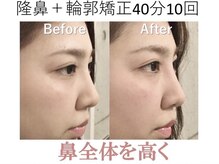 ラプリ 梅田店(Raplit)/隆鼻＋輪郭矯正40分10回