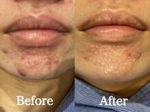 シーベル 小倉/症例写真/ハーブピーリング