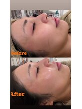 マホロバ(mahoroba)/ダーマ鍼幹細胞導入