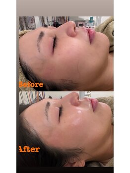 マホロバ(mahoroba)/ダーマ鍼幹細胞導入