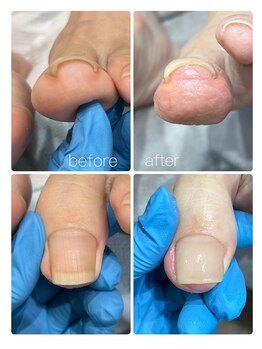 ビーユー(BeYou)/巻き爪矯正