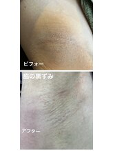 リンカ(Rinca)/脇の黒ずみ改善！フェイシャル