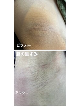 リンカ(Rinca)/脇の黒ずみ改善！フェイシャル
