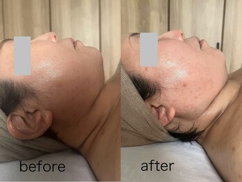 オリス(ORRIS)/ビフォーアフター(たるみ)